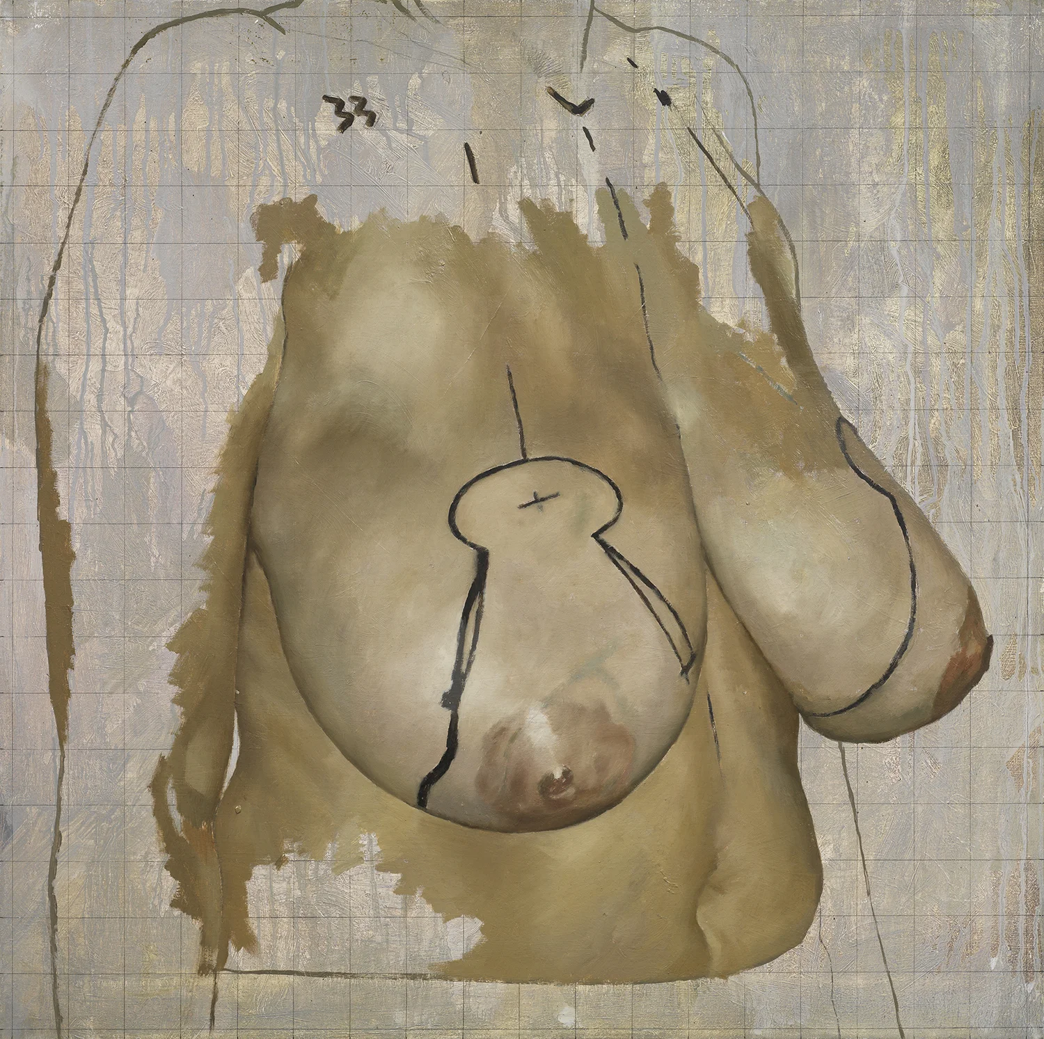 Mastopexy II.jpg