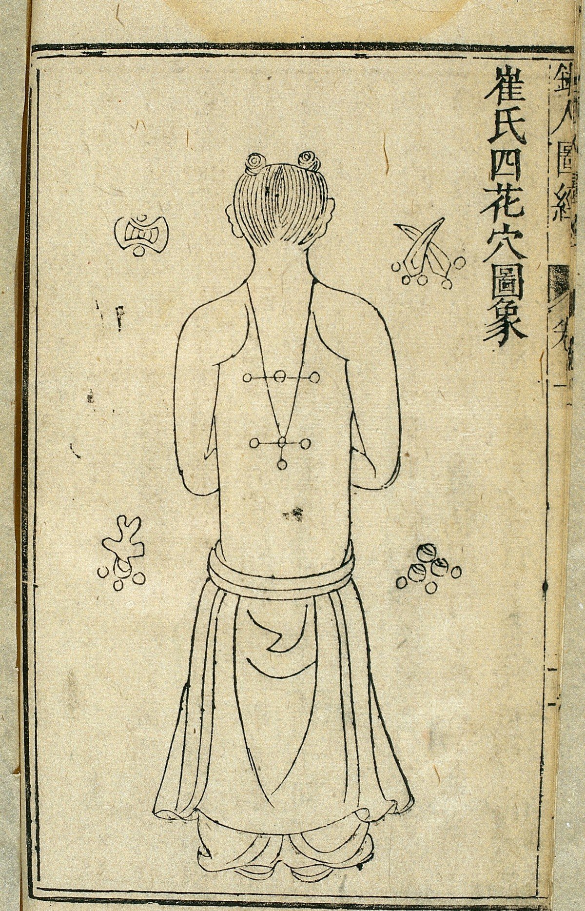 Historical Chinese medical woodcut showing the back of a standing figure with four treatment points marked on the upper and mid-back, used to illustrate the Four Flower Points.