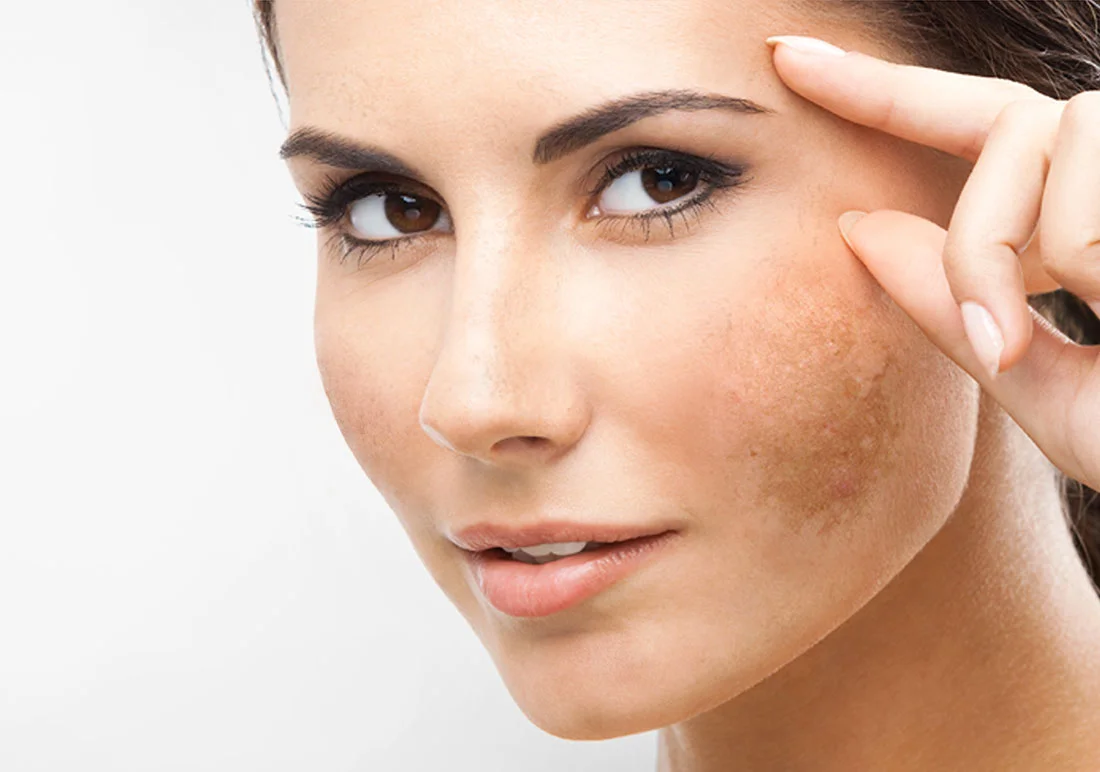 melasma-tire-esta-marca-do-rosto-6413.jpg