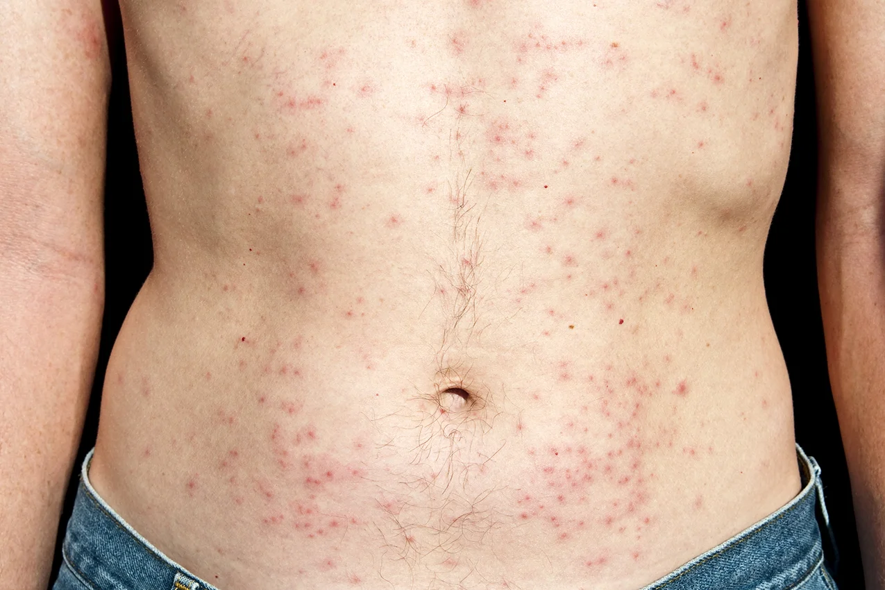 Rash.jpg
