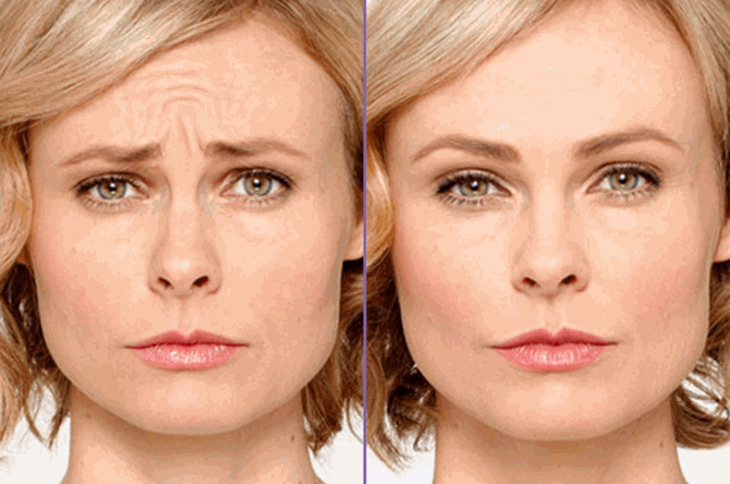 Botox-Before-and-After.gif