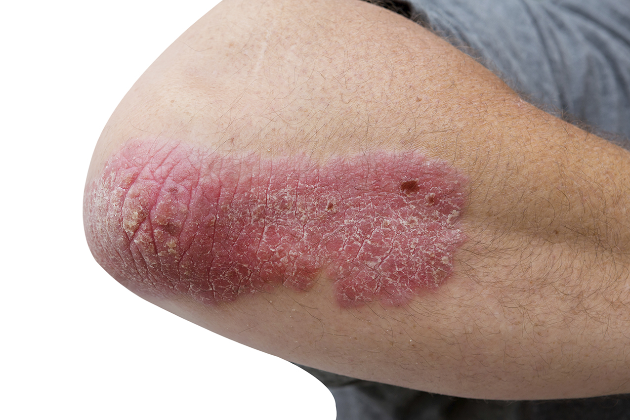 Psoriasis.jpeg