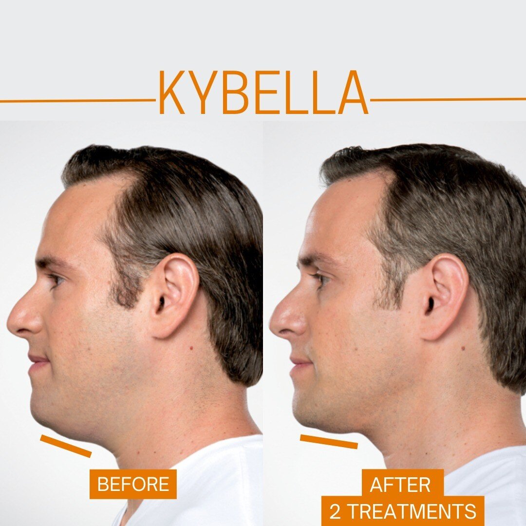 Kybella permanently targets the submental fat, commonly known as a &quot;double chin.&quot; Kybella is generally considered safe and well-tolerated. The exact number of sessions needed will depend on the individual. 

Book/Call to schedule a consulta