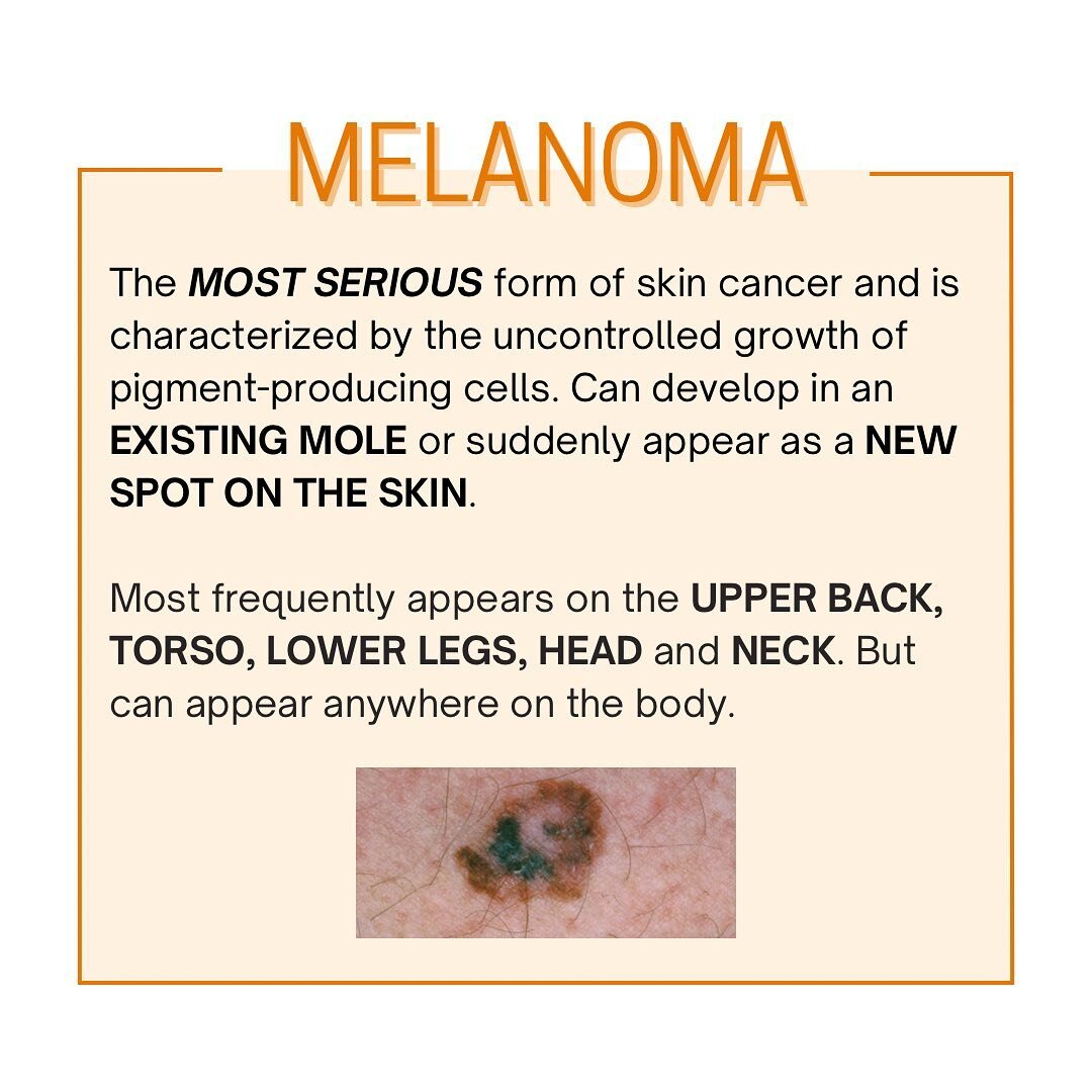 Melanoma, the most serious form of skin cancer. If you have any suspicions, contact your dermatologist for a spot check.