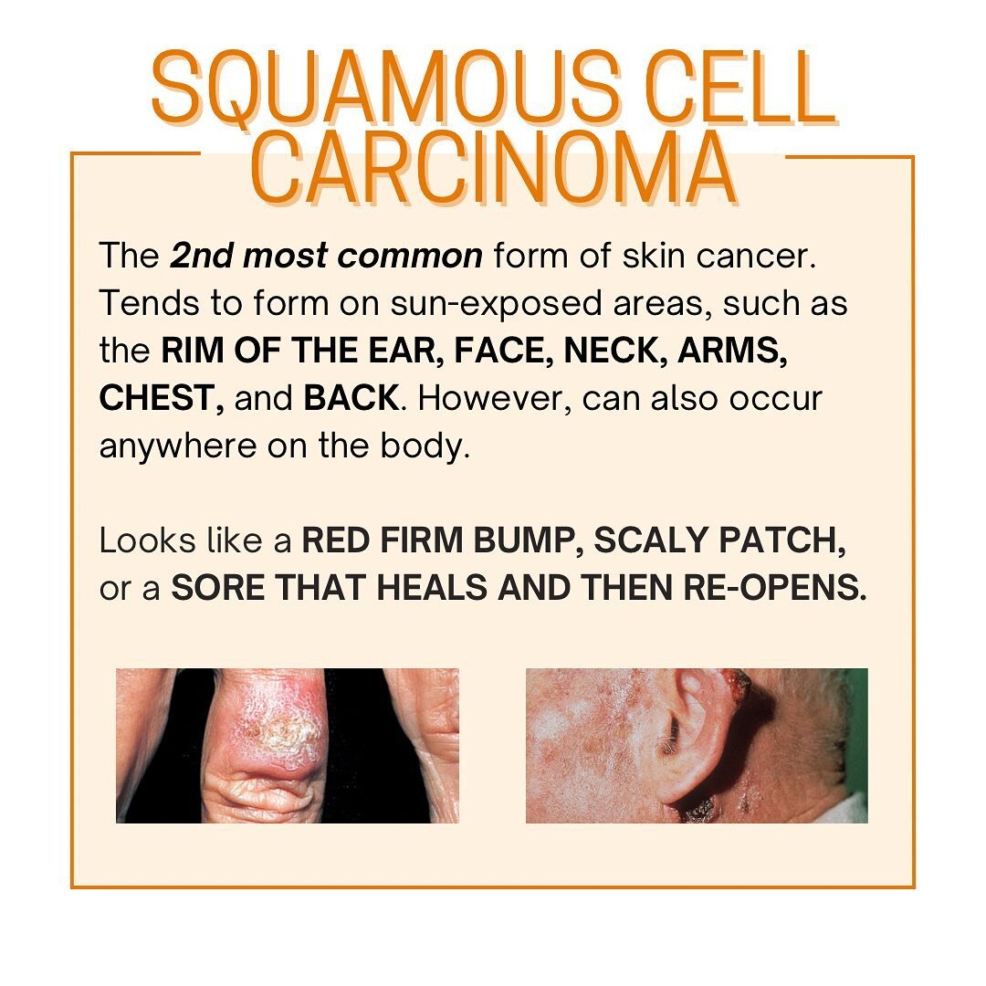 Squamous cell carcinoma is the 2nd most common form of skin cancer. Looks like a red firm bump, scaly patch, or a sore that heals and then re-opens. If you have any suspicions, contact your dermatologist for a spot check.