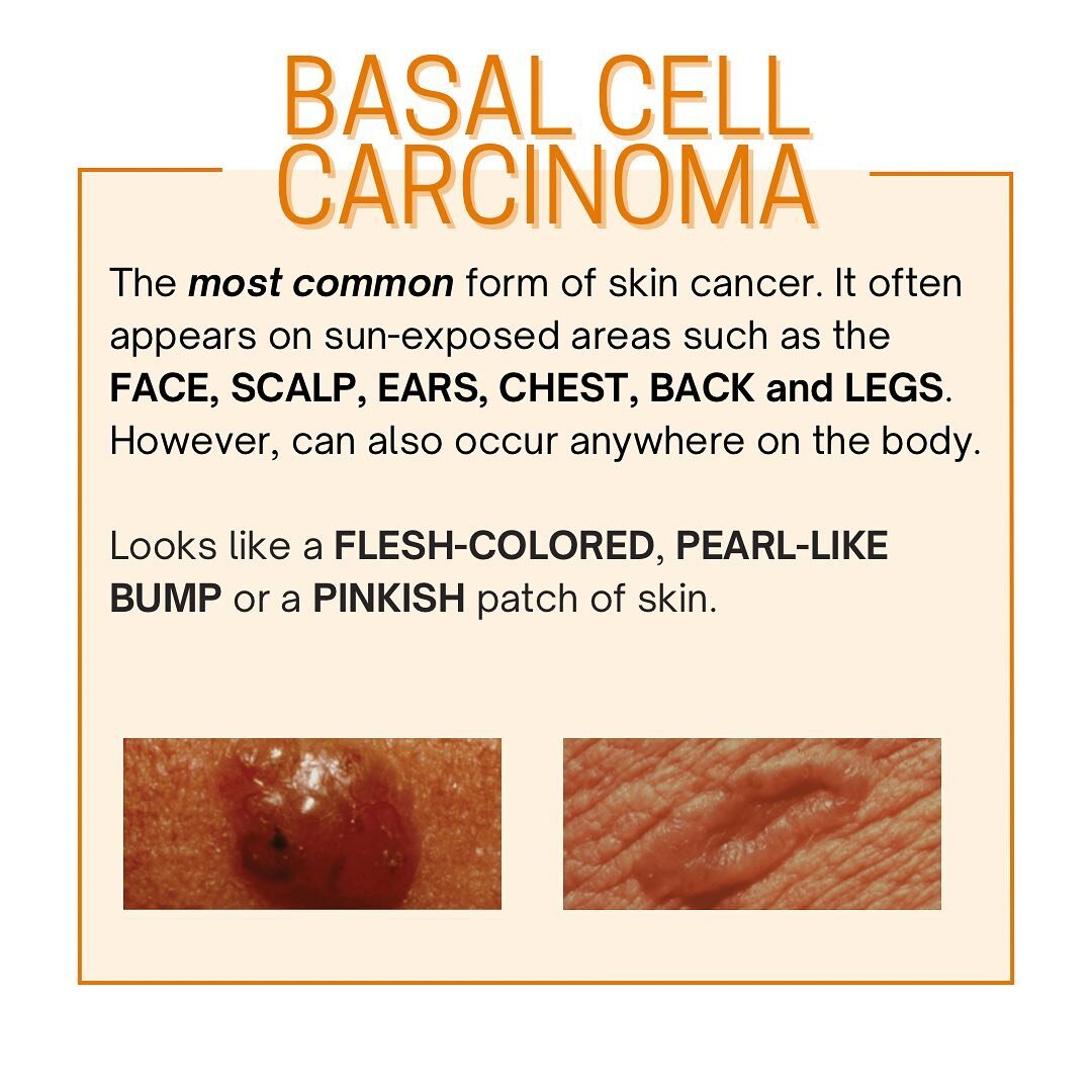 Basal cell carcinoma is the most common form of skin cancer. If you have any suspicions, contact your dermatologist for a spot check.