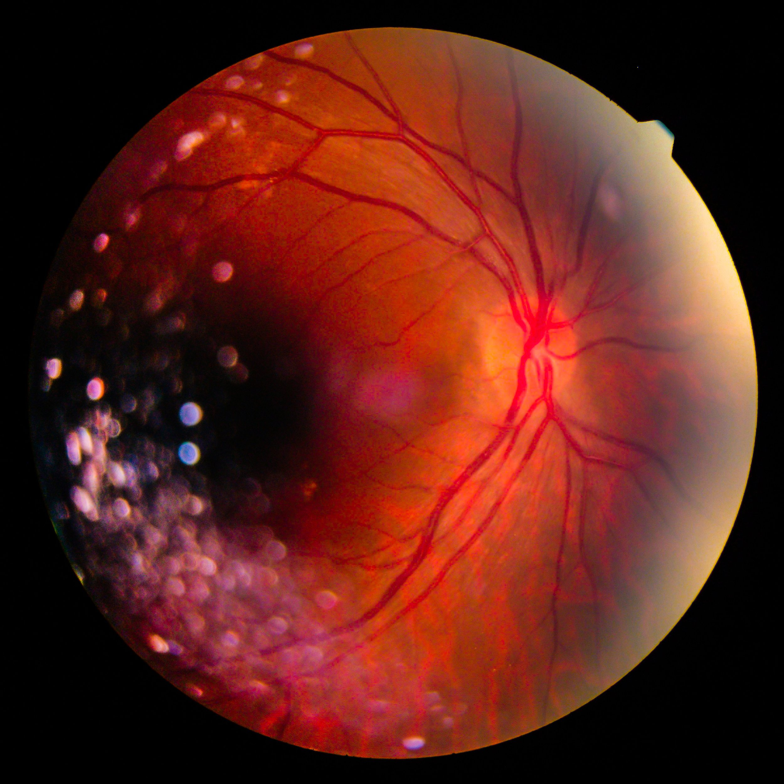 Пигментный ретинит сетчатки. Лазерная коагуляция сетчатки. Палочки сетчатки раздражаются. Диабетическая ангиопатия сетчатки капли.