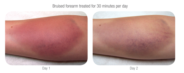 Before and after a 30 min session on arm for bruising. Within 30 min you are able to get increased circulation for rapid healing. LED travels deep into tissues and muscles of the body to repair damage. Using LED Body Therapy for targeted repair will quickly reduce pain on sight. 