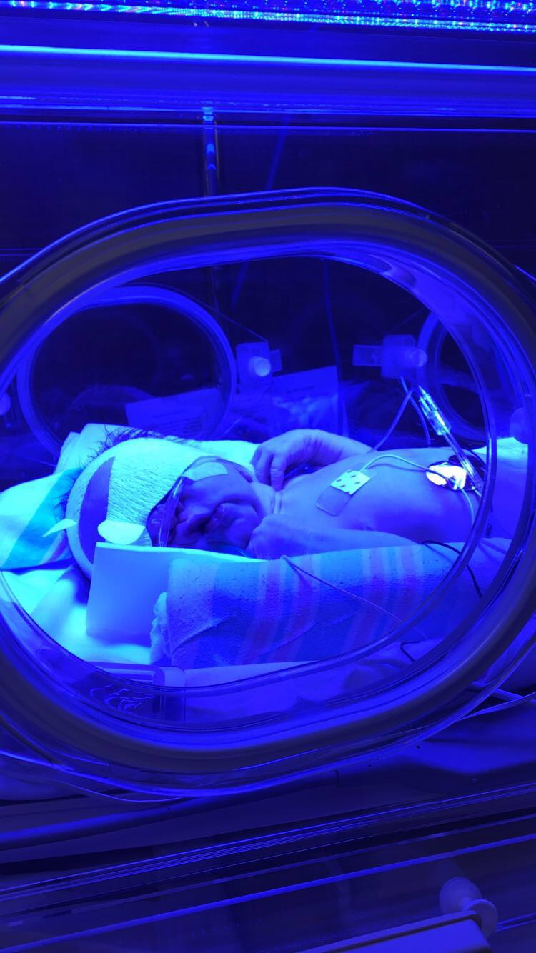 TG Under the Jaundice Lamp. Squishy Face!