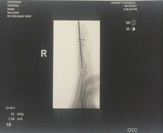 My new bionic finger.