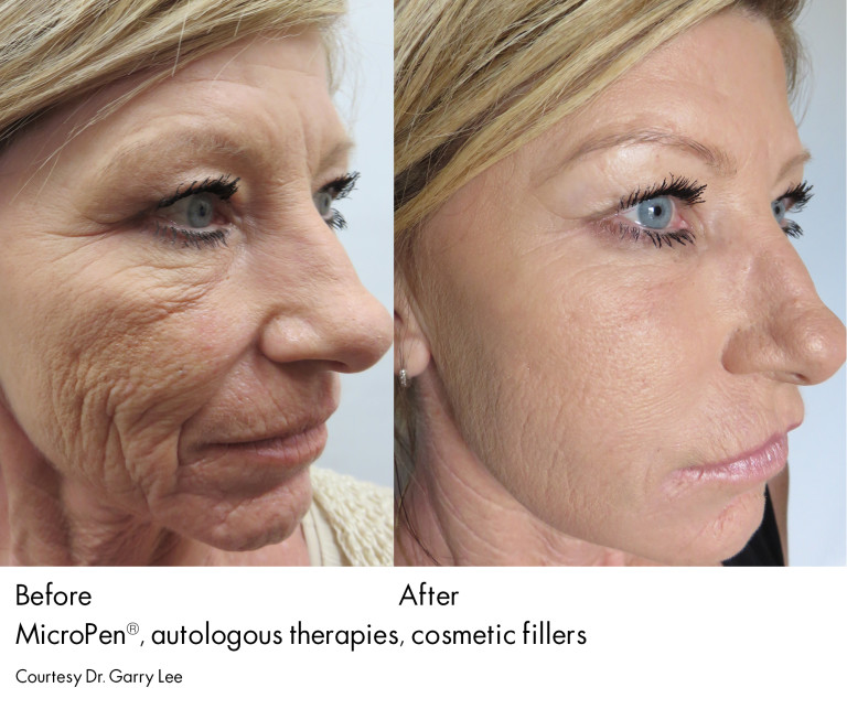 Prp Microneedling Treatment In Dc Integrated Dermatology