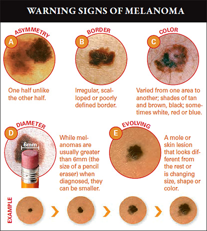 Melanoma Integrated Dermatology