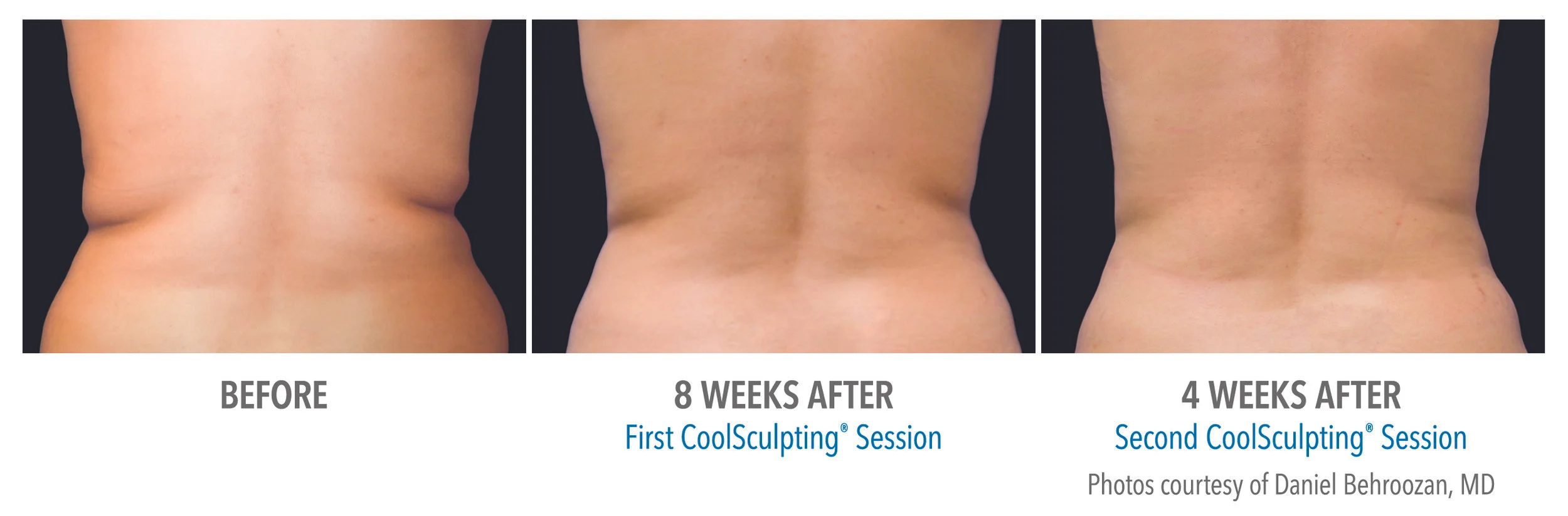 coolsculpting flanks.jpg