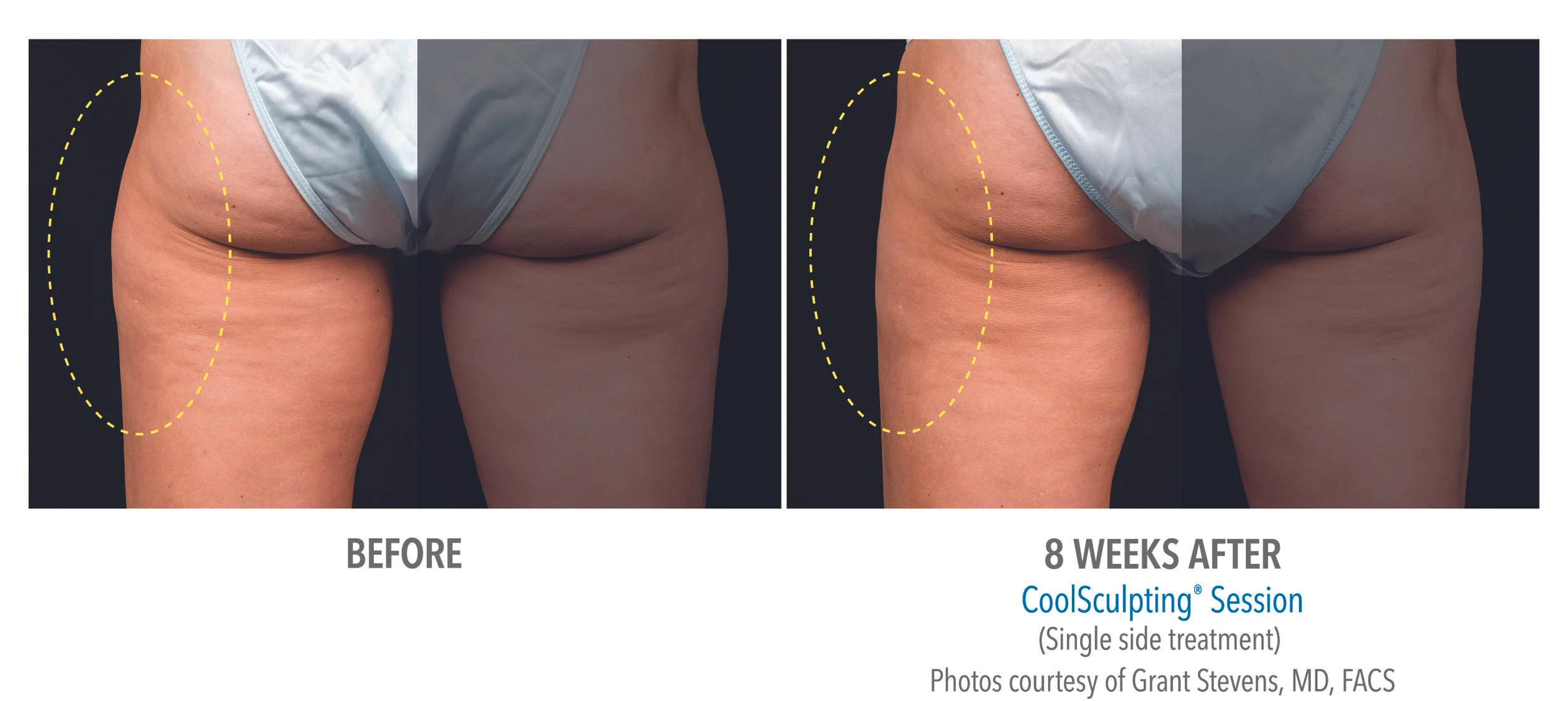 coolsculpting outer thigh.jpg