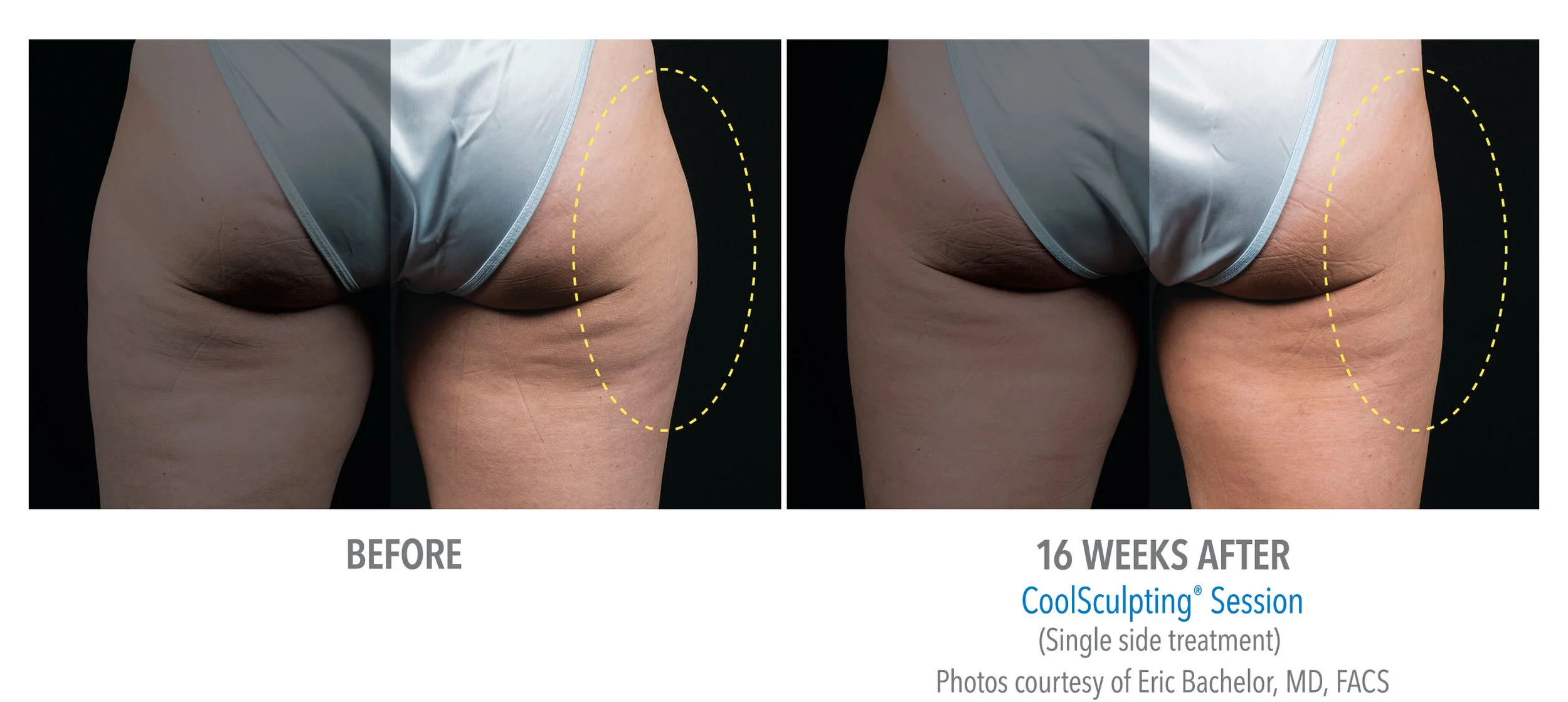 131-Female-OuterThigh-DrBachelor-Medium - Copy.jpg