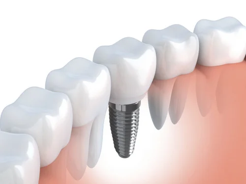 Dental-Implant-Model-Implant-Post-with-Gums.jpg