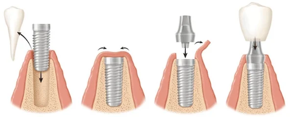 costa-rica-dental-implants-steps.jpg