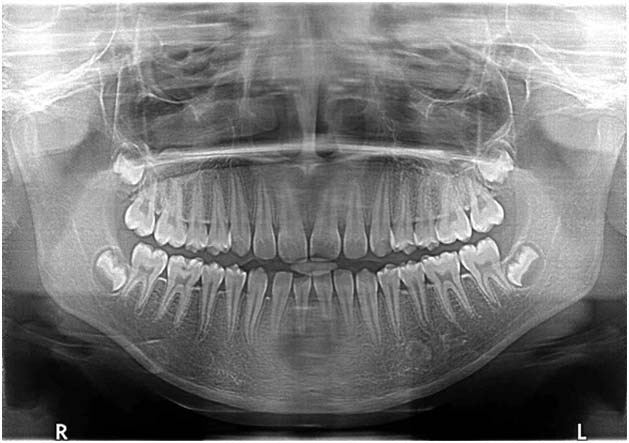 Panoramic X-Ray