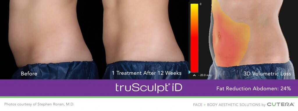 truSculpt-iD-Ronan-4-1024x381.jpg