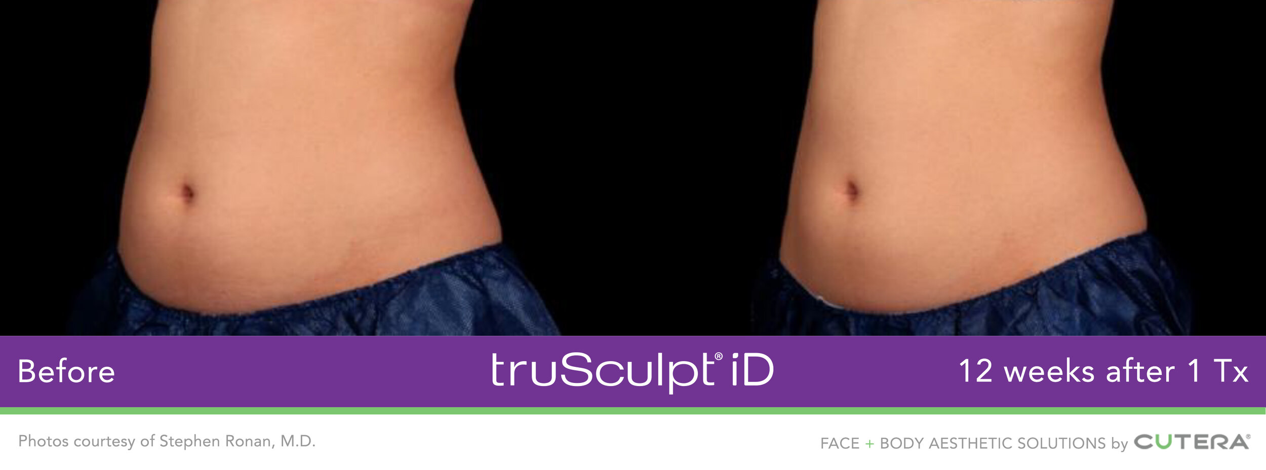 truSculpt-iD-Ronan-3.jpg