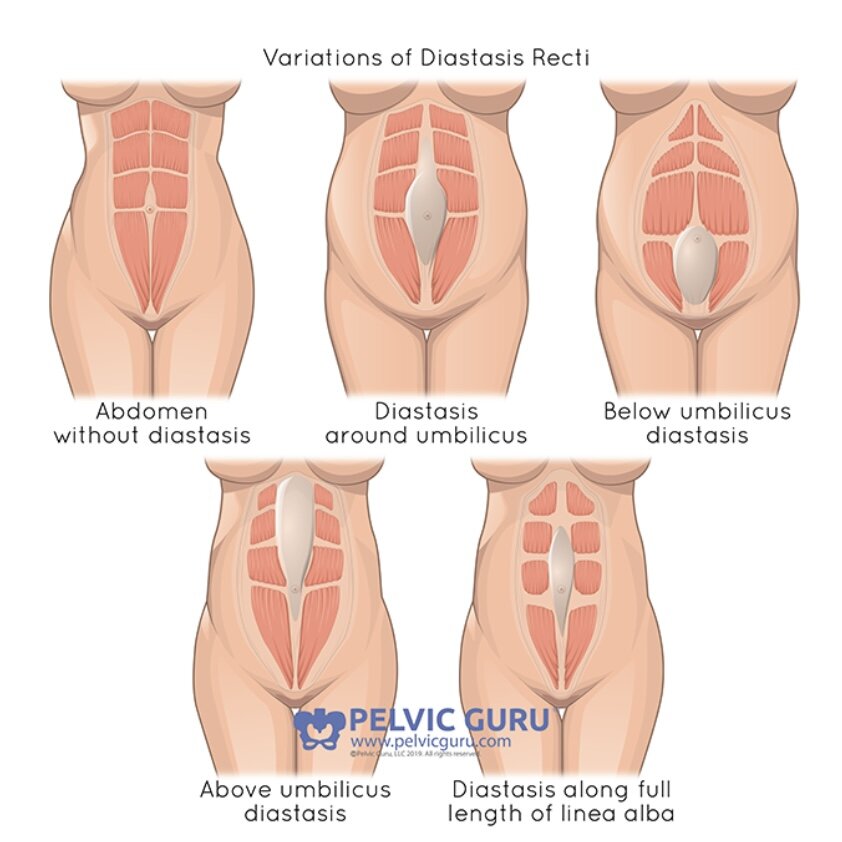 What Is Diastasis Recti and How Do I Know If I Have It? — Bud & Bloom  Physical Therapy