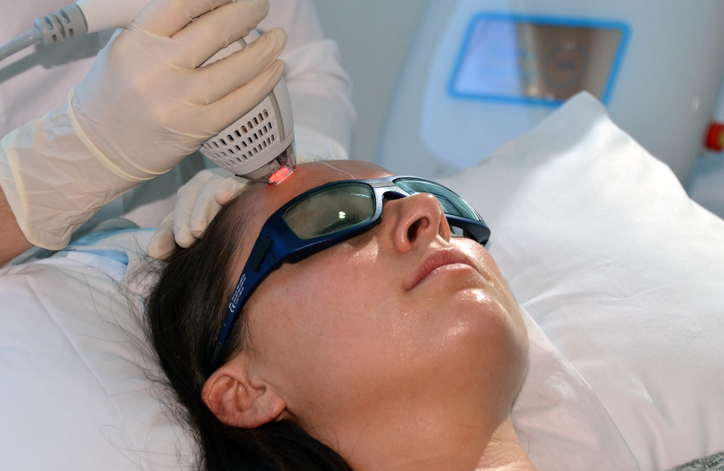 Clear and brilliant laser - treat skin ageing early and subsequently slow the ageing process.