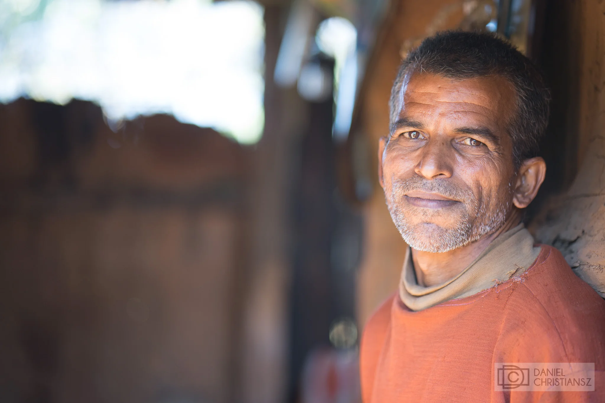 Man from Nepal affected by Leprosy
