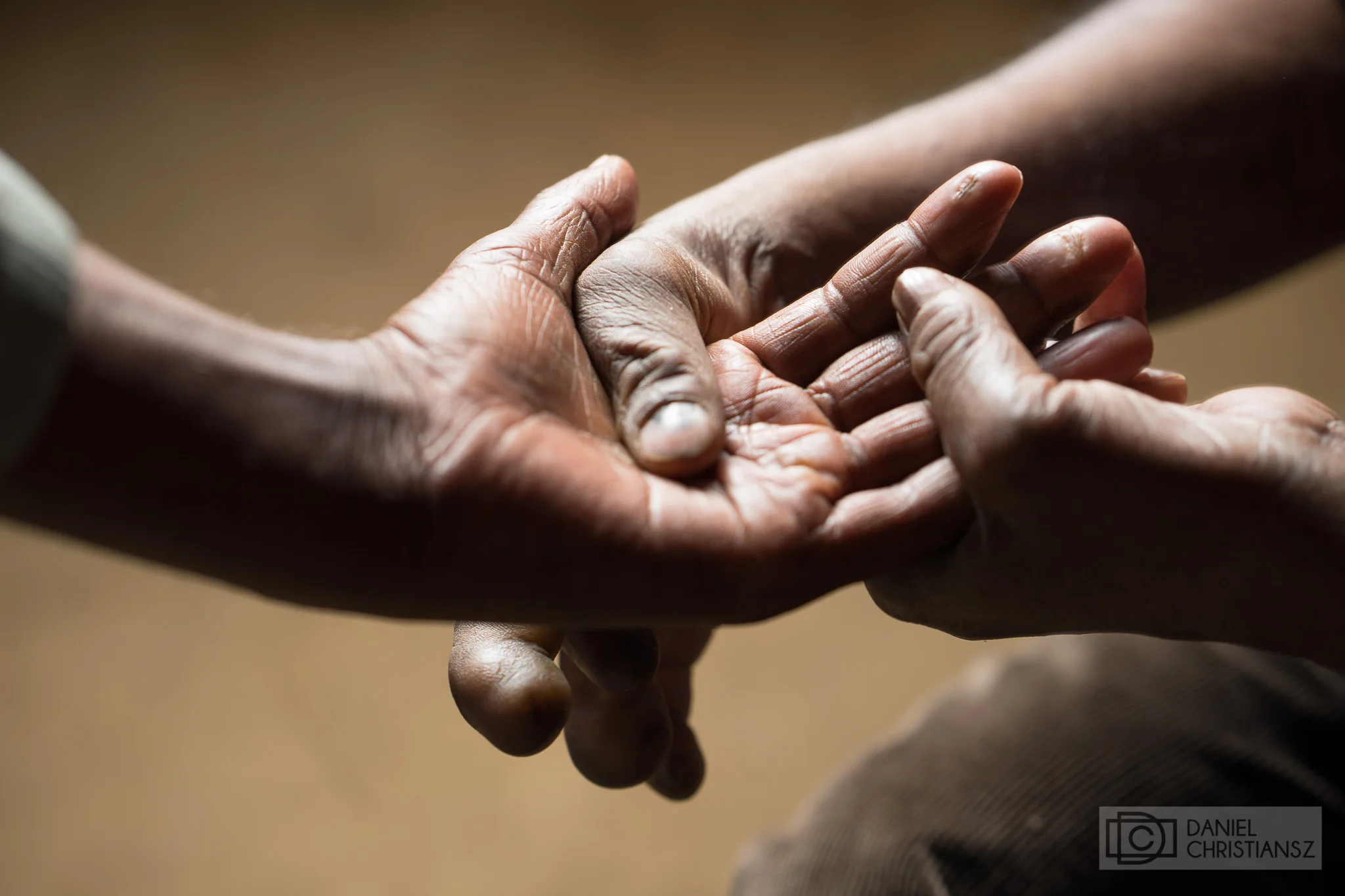 Hand Therapy for Leprosy Patients