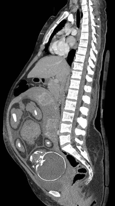 CT during pregnancy.jpg