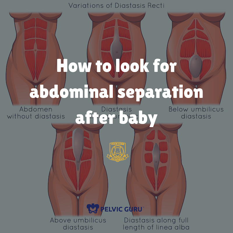 Diastasis.png