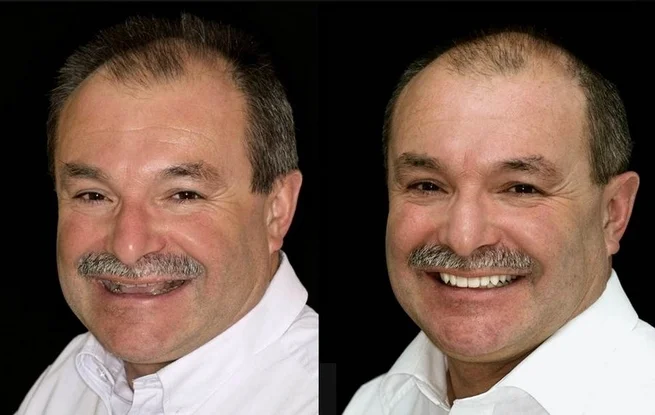 Before and After Restorative