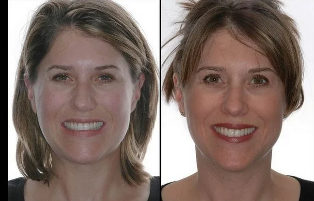 Before and After Restorative