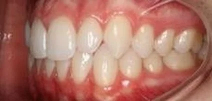 After Orthodontics and Restorative