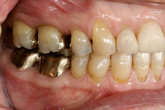 Before Orthodontics and Restorative