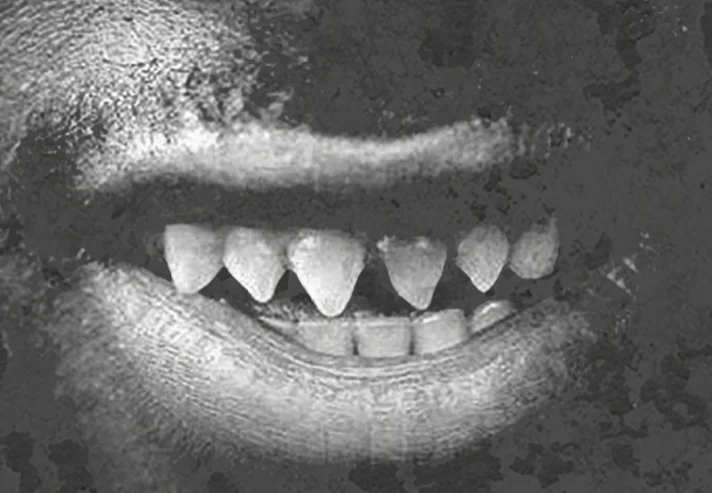 Human tooth sharpening is the practice of manually sharpening the teeth, usually the front incisors. Historically it was done for spiritual purposes, with some exceptions, but in modern times it is usually aesthetic in nature as an extreme form of body modification. 