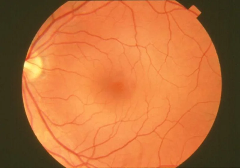 The image shows a normal appearing retina for comparison.