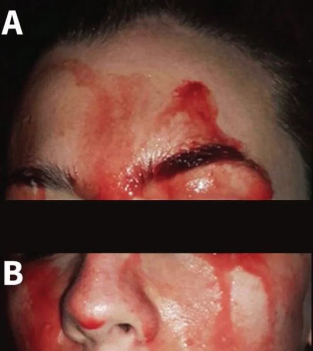 Bleeding discharge from the forehead (A) and lower face (B) of a 21-year-old woman. |Canadian Medical Association Journal