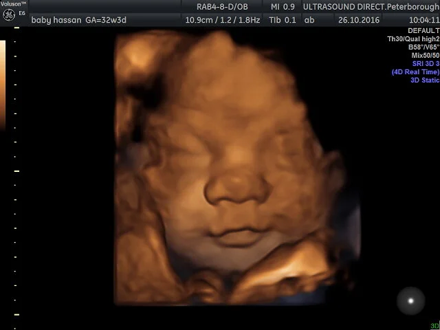 Pickle's 4D Bonding Scan | Ultrasound Direct, Peterborough | Me ...