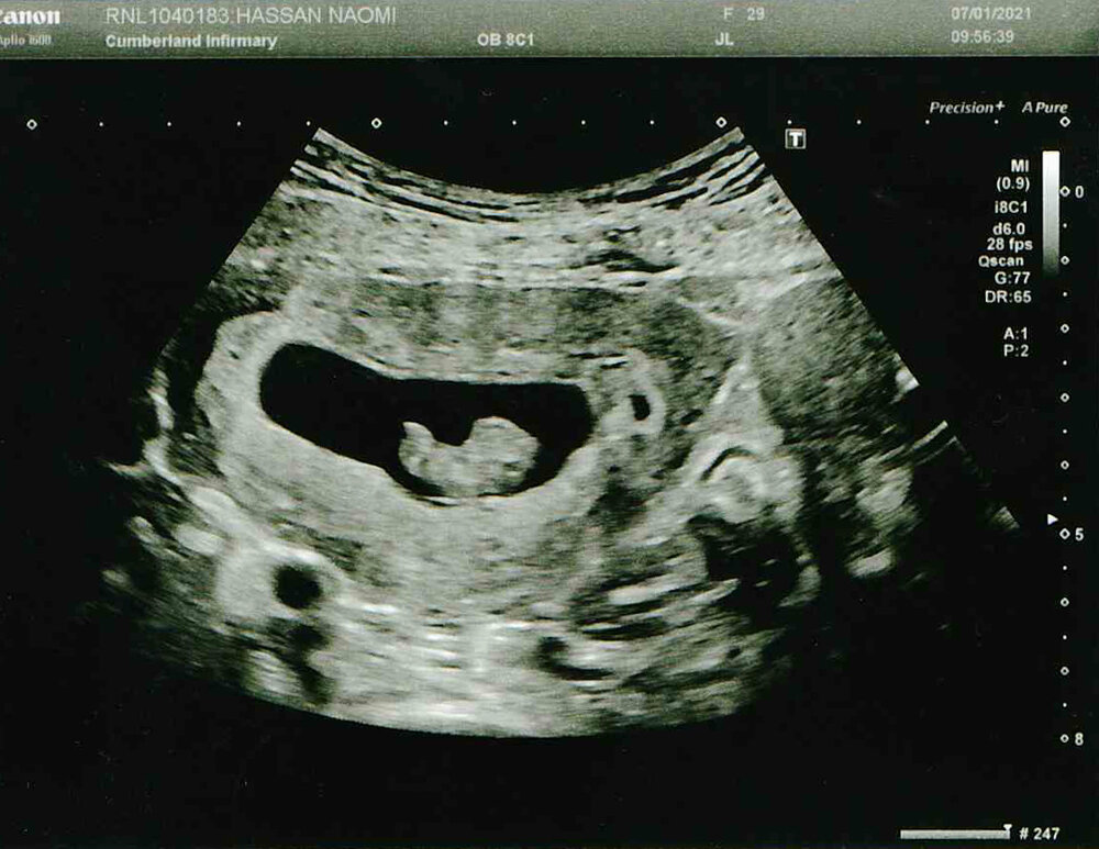 Peanut's early reassurance scan.jpg