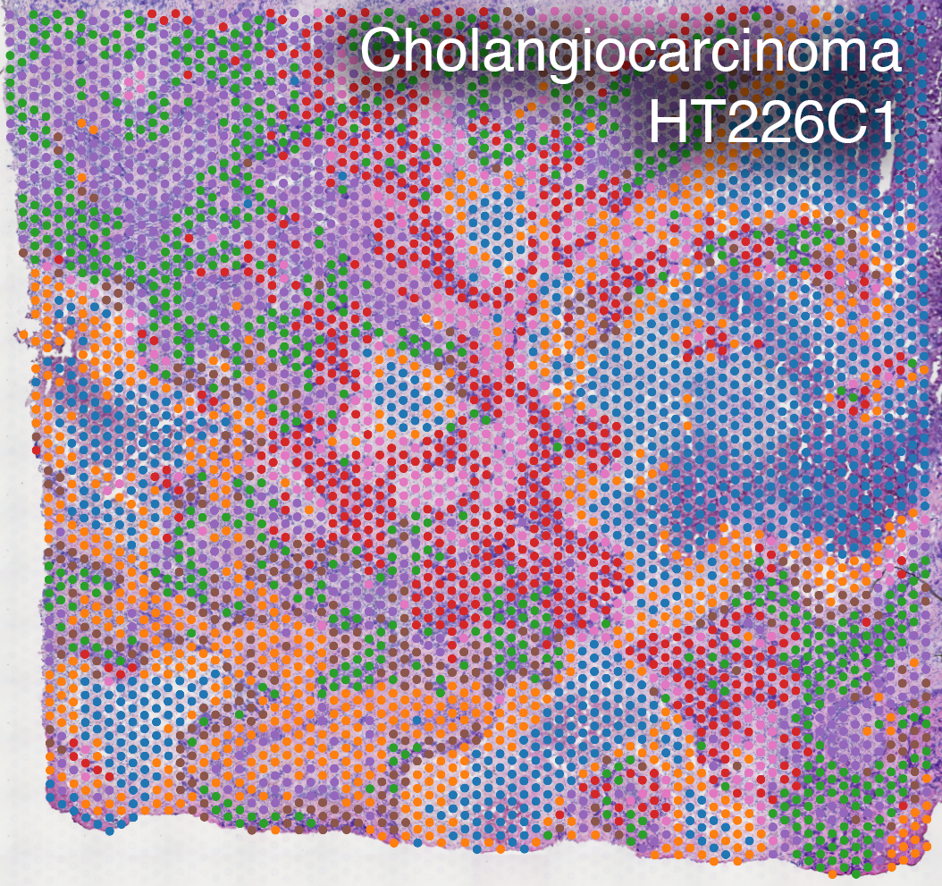 Cholangio_HT226C1.png