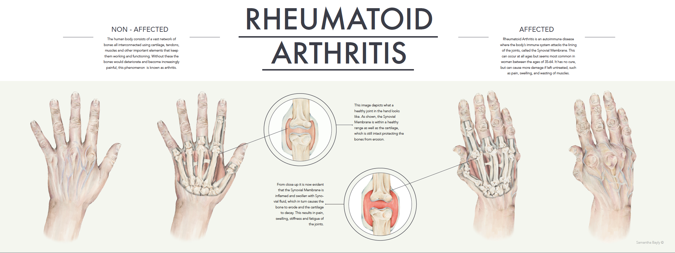 Rheumatoid Arthritis Infographic