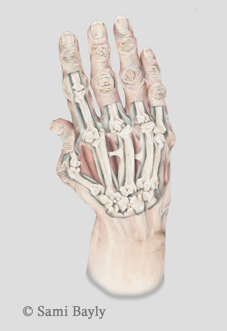 X-ray Arthritic Hand