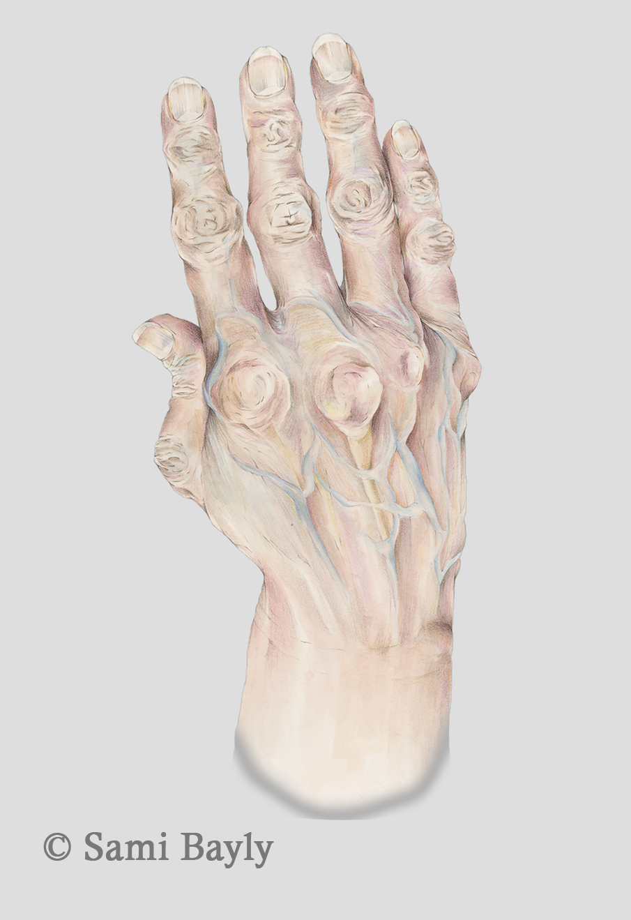Arthritic Hand