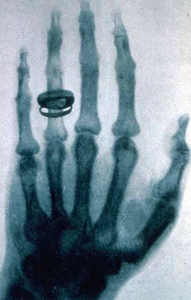 Röntgenaufnahme:Albert von Koellikers Hand, aufgenommen von Conrad Röntgen am 23. Januar 1896 (wikimedia)