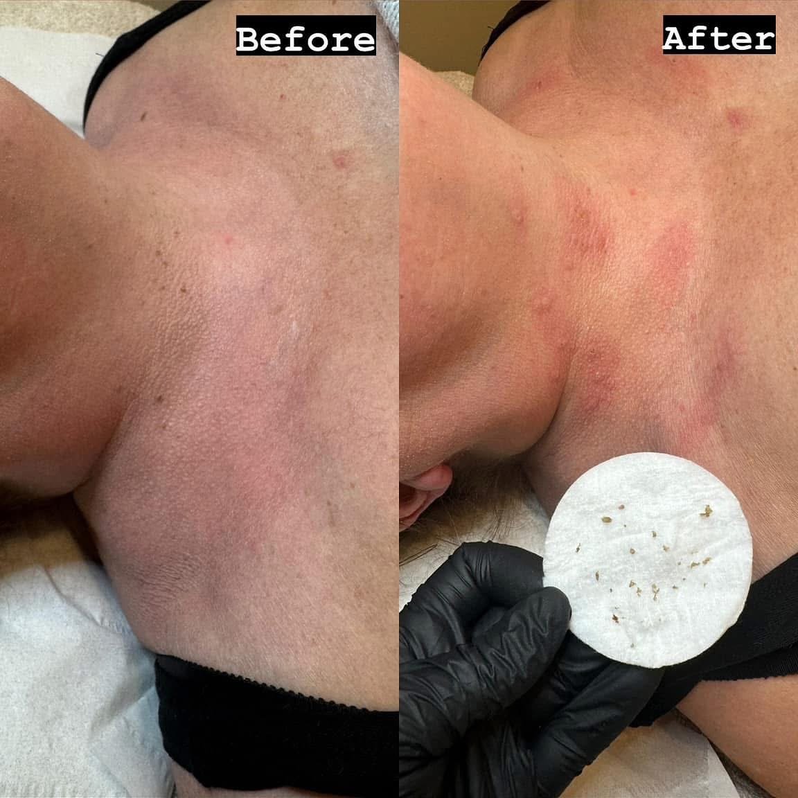 Say bye bye to inwanted blemishes 👋🏻

ACP Blemish Removal Treatment 
Booking links in our bio 🔗

#blemishremoval
#smoothskin
#haslingdenbeautysalon