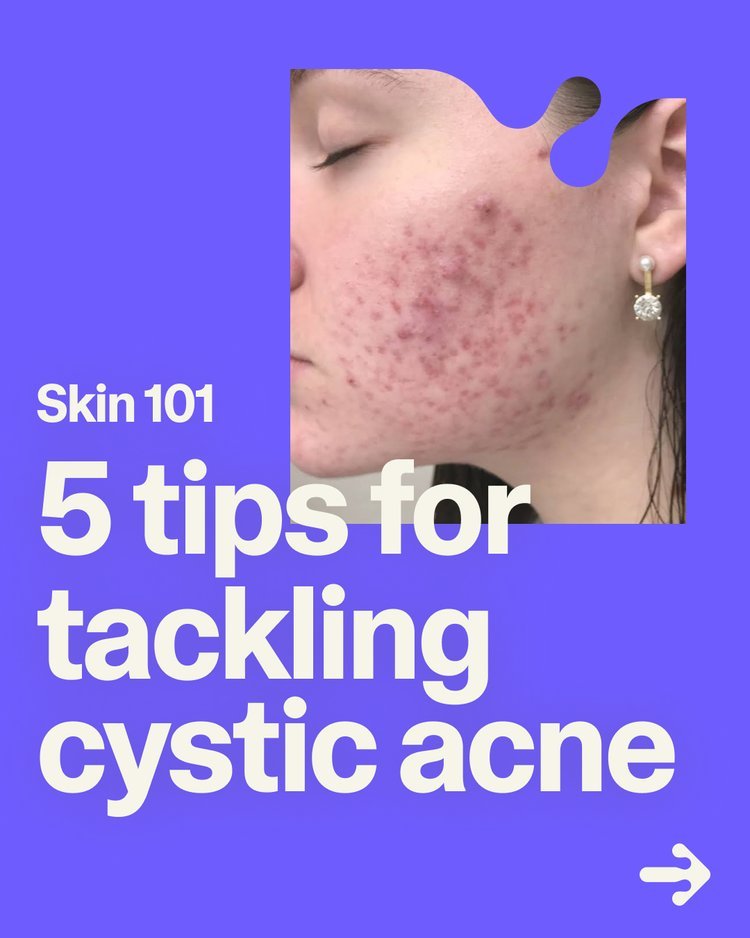 Feb.+8+—+Skin101_+What+is+Cystic+Acne_+1.jpg