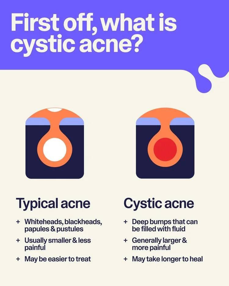Feb.+8+—+Skin101_+What+is+Cystic+Acne_+(Carousel)+2.jpg