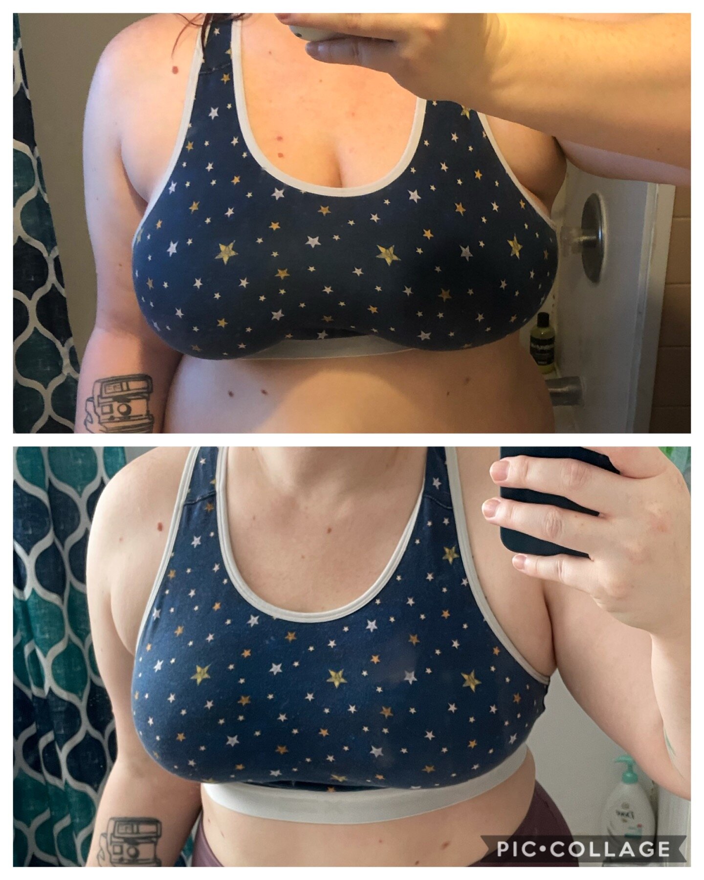 My Breast Reduction Story: Before, During, and After — DUTCHER