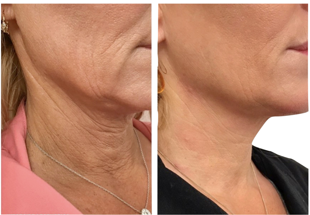 Need A Neck Fix Coming Right Up Hyperdiluted Radiesse Anthony Loren Skincenter Of Tampa