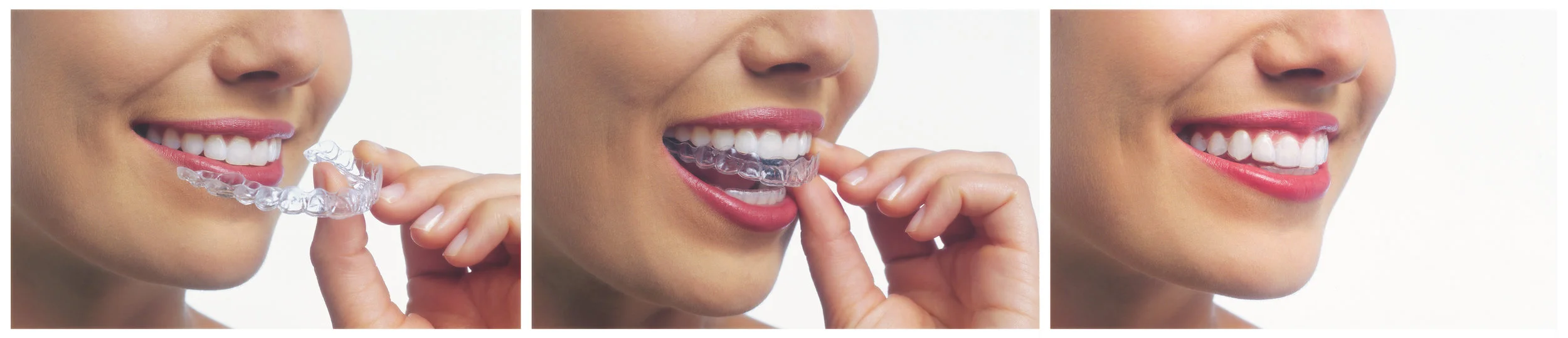 invisalign_profile_mouth.jpg